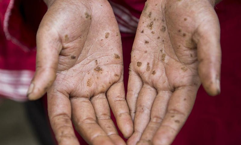 Bangladeshi women showing her hands showing effects of arsenic poisning